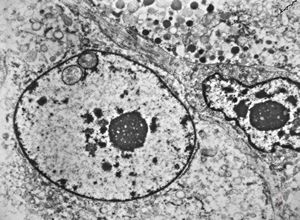 M,58y. | retroperitoneal liposarcoma M,58y. | retroperitoneal liposarcoma